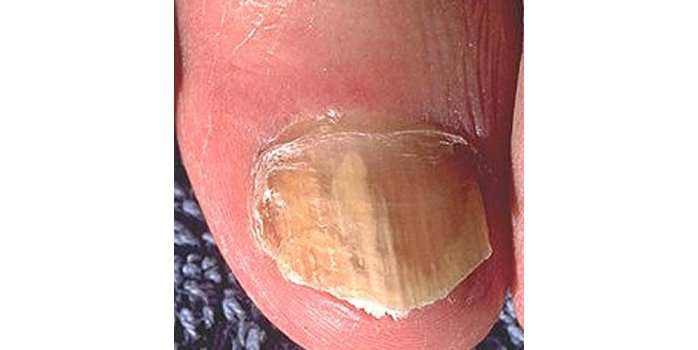 Onychomycosis remains a major clinical challenge | Lower Extremity Review  Magazine